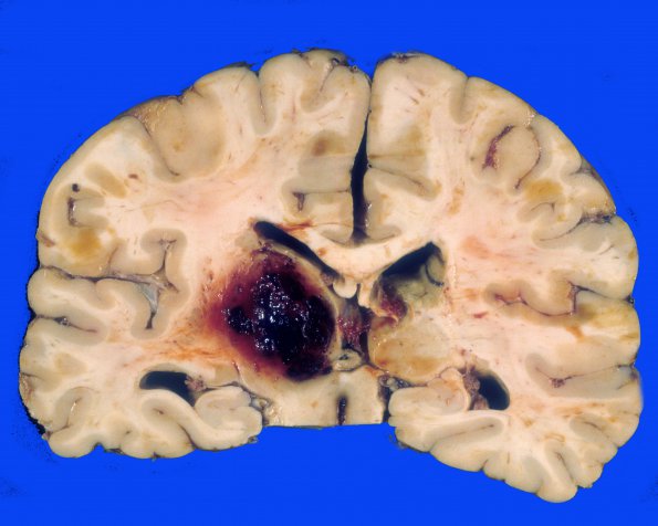 6 Hemorrhage, hypertensive (Case 6)