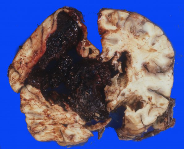 7 Hemorrhage, hypertensive (Case 7)