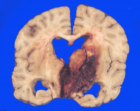 8 Hemorrhage, hypertensive (Case 8) 1