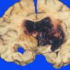 9 Hemorrhage, hypertensive (Case 9) 1