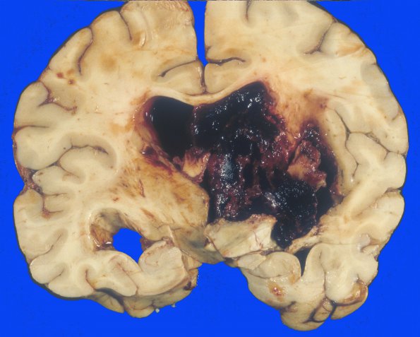 9 Hemorrhage, hypertensive (Case 9) 1