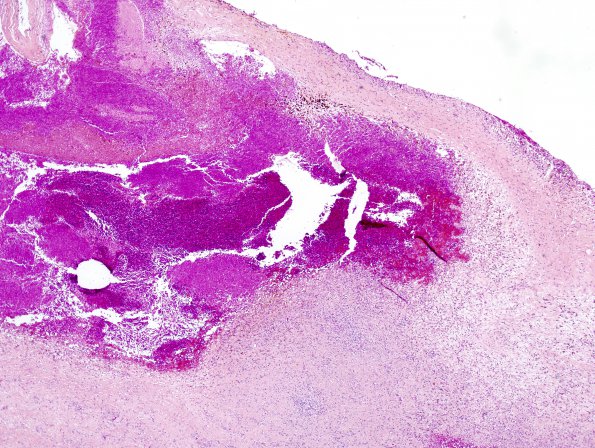 10A1 Hemorrhage, Subdural (Case 10) H&E 4