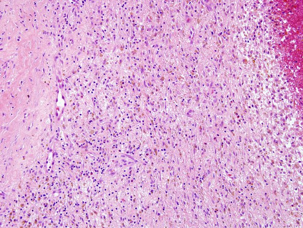 10A2 Hemorrhage, Subdural (Case 10) H&E 1