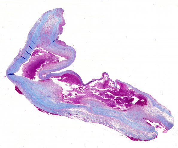 10A3 Hemorrhage, Subdural (Case 10) Trichrome 1