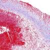 10A4 Hemorrhage, Subdural (Case 10) Trichrome 3