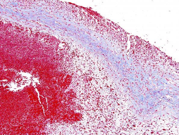 10A4 Hemorrhage, Subdural (Case 10) Trichrome 3