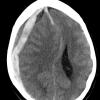 11A1 Hemorrhage, subdural, recent, uncal herniation (A15-96) CT 1 - Copy