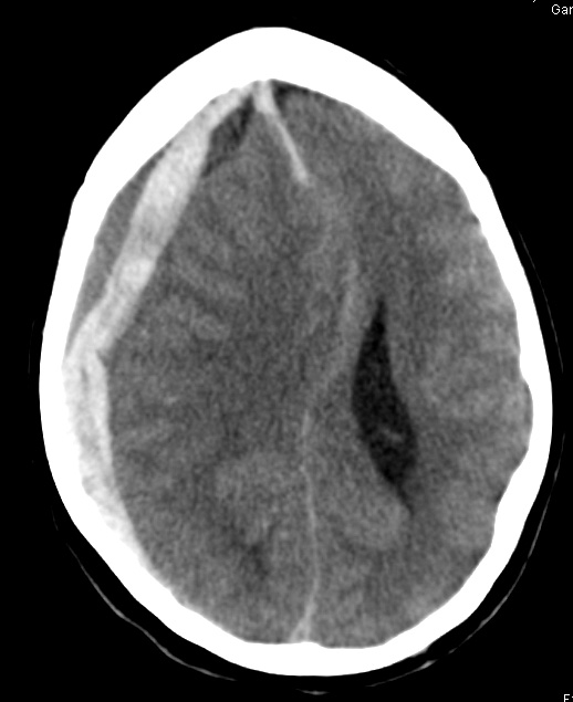 11A1 Hemorrhage, subdural, recent, uncal herniation (A15-96) CT 1 - Copy