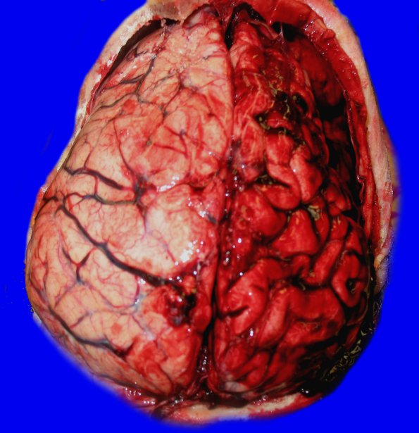 11B1 Hemorrhage, subdural (A15-96) & herniation _1