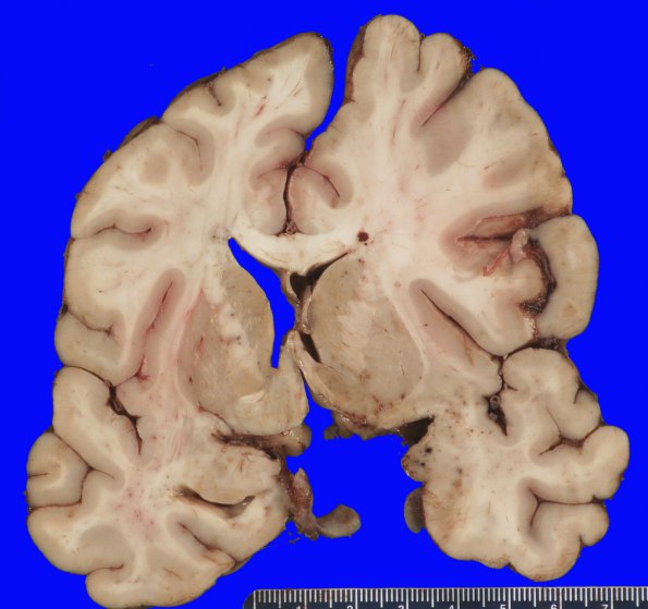 11B3 SDH (Case 11) 8