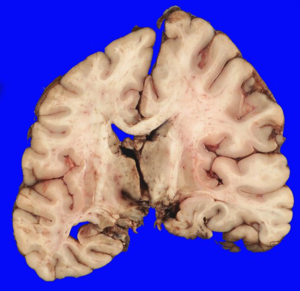 11B4 Hemorrhage, subdural (Case 11) & herniation _7