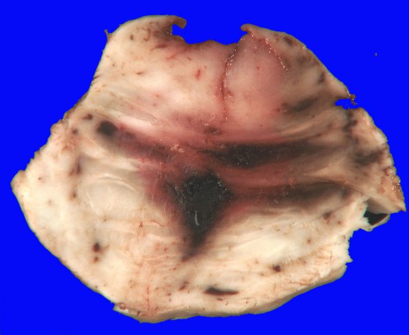 11B5 Hemorrhage, subdural (Case 11) & herniation _3