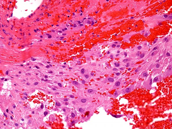 12A2 Hemorrhage, subdural, florid organization (Case 12) H&E 1