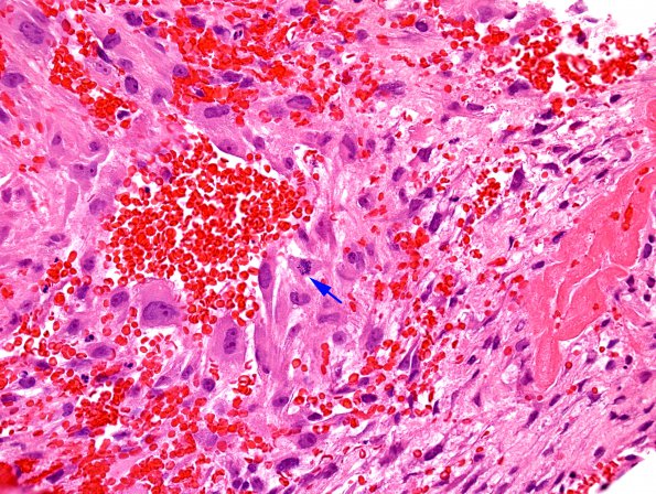 2A3 Hemorrhage, subdural, florid organization (Case 12) H&E 2 copy