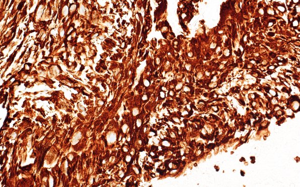 12B2 Hemorrhage, subdural, florid organization (Case 12) A1 VIM 40X 2