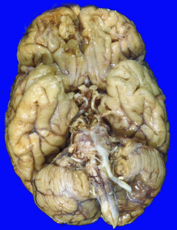 13A1 Contusion, PD, roof fall 1 yr prior & Infarct, chronic SDH membrane remote (Case 13) 4