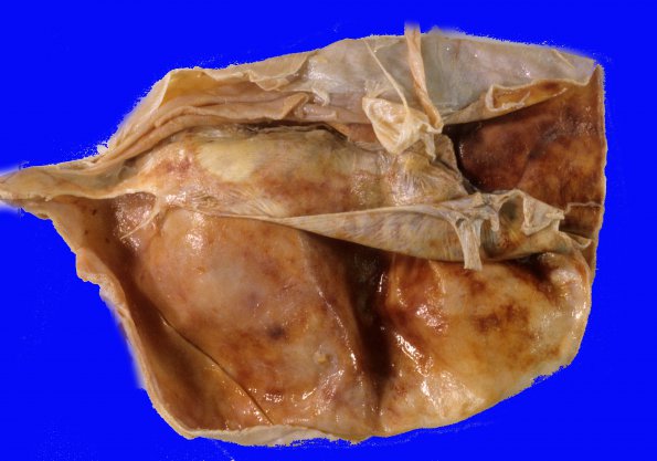 13A2 Hemorrhage, subdural (Case 13) 2