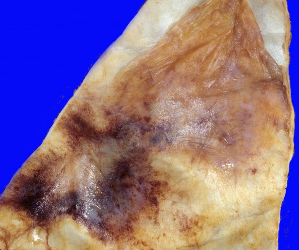 13A3 Hemorrhage, subdural (Case 13) A1 (2)