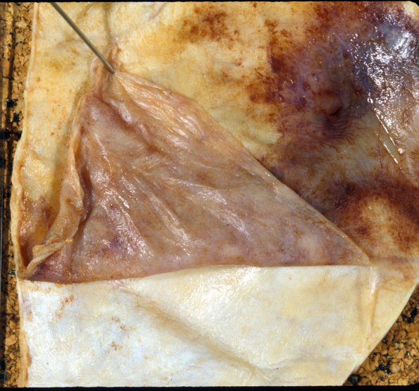 13A4 Hemorrhage, Subdural (Case 13) 1 membrane