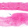 13B1 Hemorrhage, Subdural (Case 13) H&E 4X copy