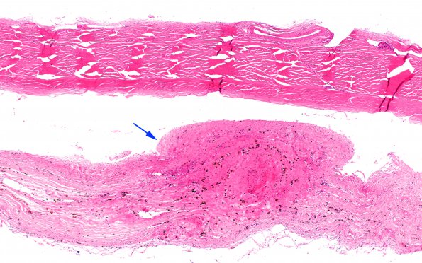 13B1 Hemorrhage, Subdural (Case 13) H&E 4X copy