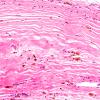 13B2 Hemorrhage, Subdural (Case 13) H&E 20X