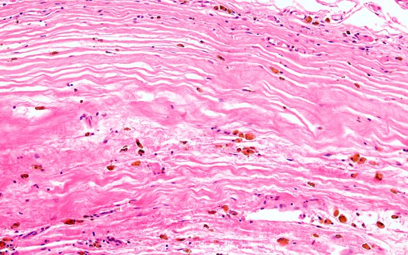 13B2 Hemorrhage, Subdural (Case 13) H&E 20X