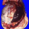 15A1 Hemorrhage, subdural (Case 15) 1