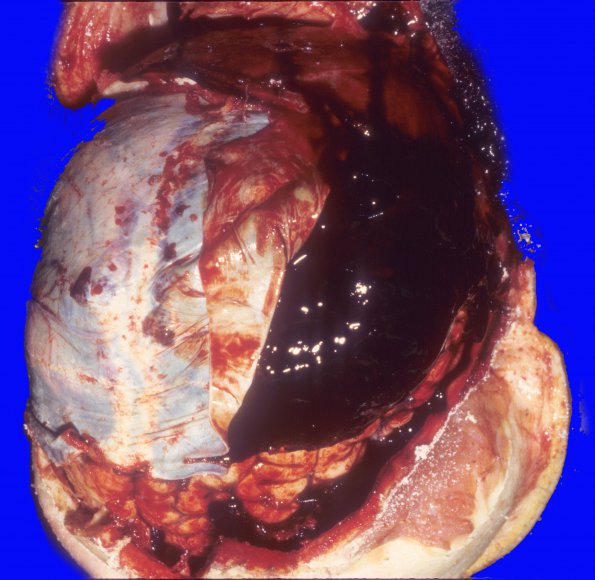 15A1 Hemorrhage, subdural (Case 15) 1