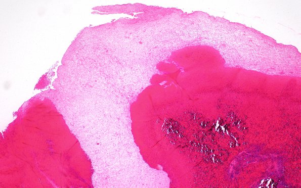 15B SDH (Case 15) N11 H&E 4X