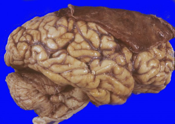 17A1 Hemorrhage, subdural (Case 17A) 1