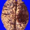 17A2 Hemorrhage, subdural (Case 17A) 2 (2)