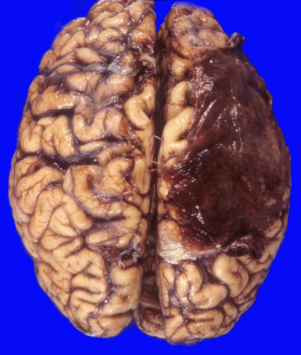 17A2 Hemorrhage, subdural (Case 17A) 2 (2)