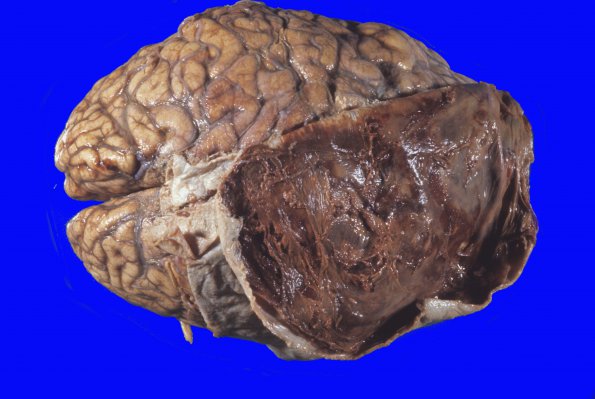 17C Hemorrhage, Subdural (Case 17C) gross 1