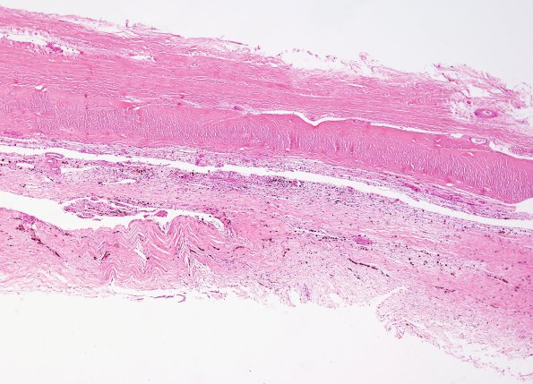 18A1 Hemorrhage, subdural, remote (Case 18A) H&E 1