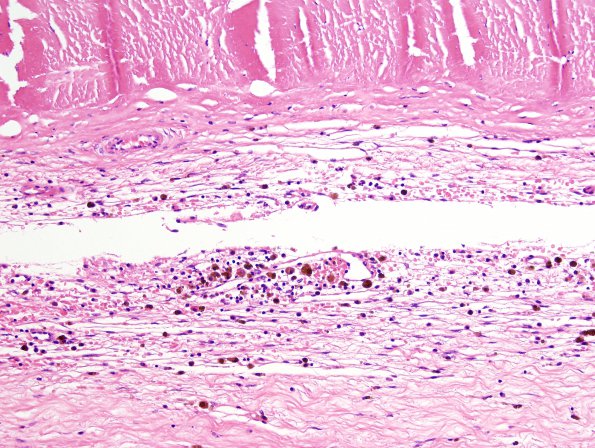 18A2 Hemorrhage, subdural, remote (Case 18A) H&E 2