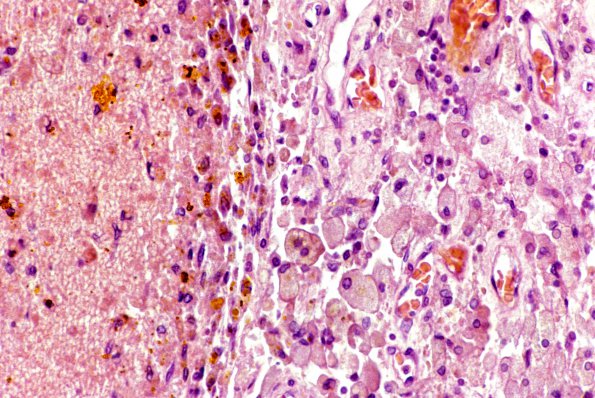 18B Hemorrhage, subdural (Case 18B)H&E 1