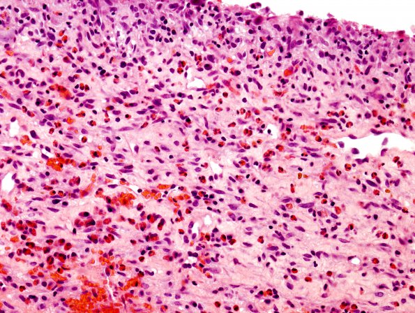 18C Hemorrhage, Subdural & Eos (Case 18C)