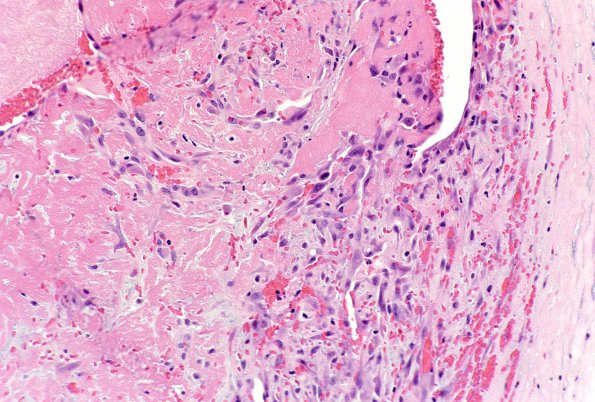 18D Hemorrhage, subdural, organizing (Case 18D) 1