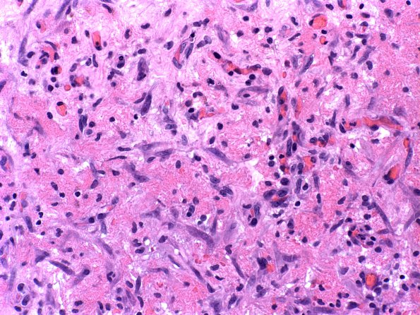 18E2 Hemorrhage, subdural, organizing (Case 18E) H&E 1