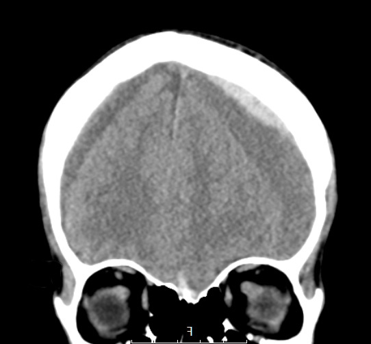19A1 CA SDH (Case 19) CTnoC 2 - Copy