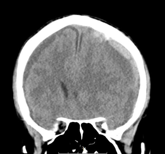 19A2 CA SDH (Case 19) CTnoC copy - Copy