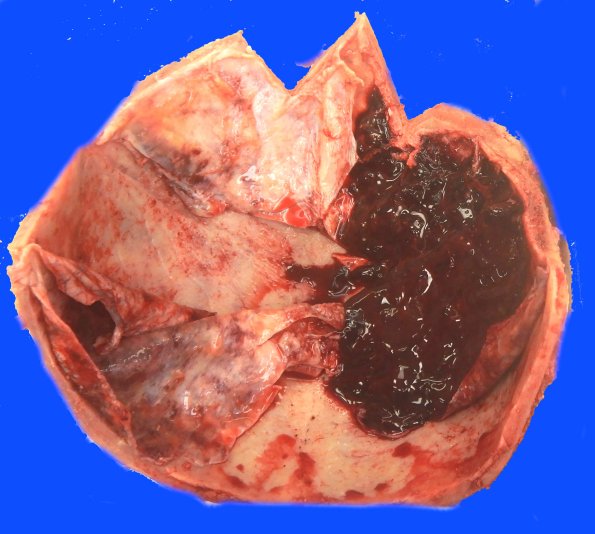 19B1 CA SDH (Case 19) Gross_1