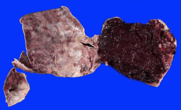 19B2 CA SDH (Case 19) Gross_1A