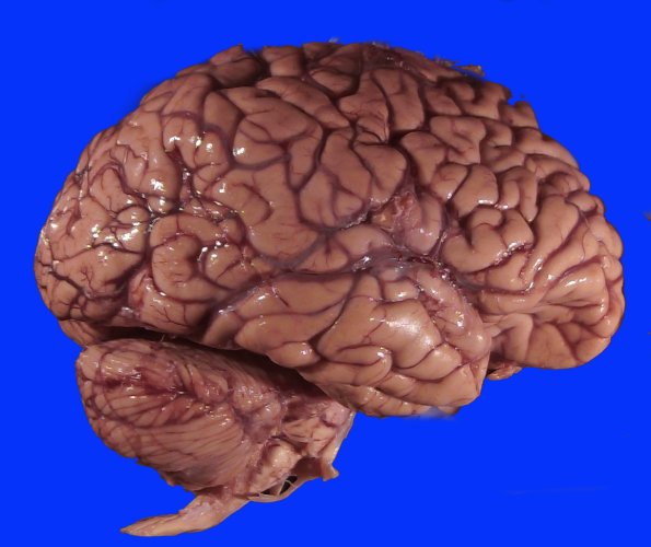 19C1 CA SDH (Case 19) Gross_4