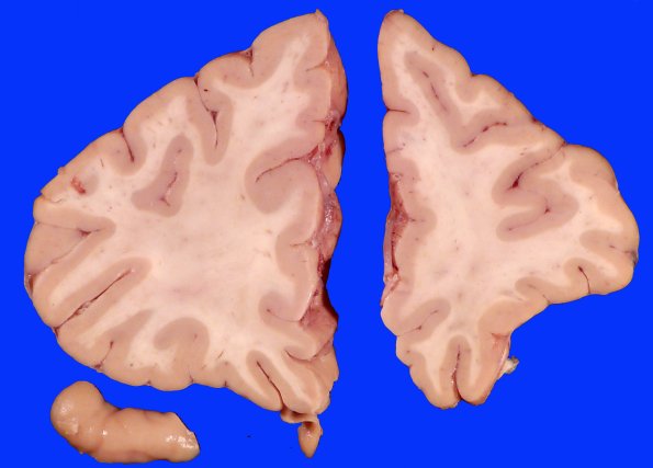 19C2 CA SDH (Case 19) Gross_5