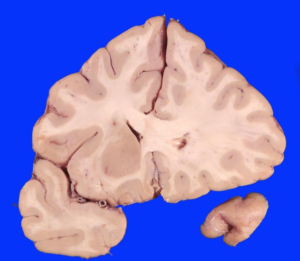 19C3 CA SDH (Case 19) Gross_7