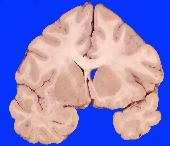19C4 CA SDH (Case 19) Gross_8