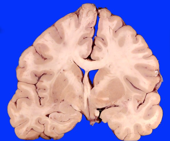 19C5CA SDH (Case 19) Gross_9