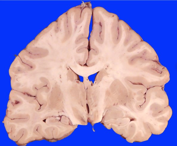 19C6 CA SDH (Case 19) Gross_10